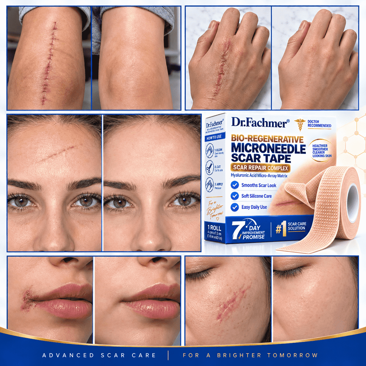 🔥 𝐎𝐟𝐟𝐢𝐜𝐢𝐚𝐥 𝐒𝐭𝐨𝐫𝐞丨Dr.Fachmer® 🩹 Bio-Regenerative Microneedle Scar Tape——Remove all kinds of skin scars